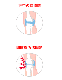 膝関節